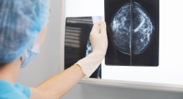 ¿Cuántos minutos de ejercicios por semana? Por qué los oncólogos necesitan guías precisas para incentivar a sus pacientes