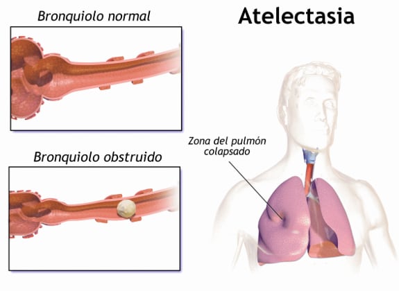 Qué es y de qué forma afecta la atelectasia