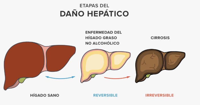 Las etapas del daño hepático