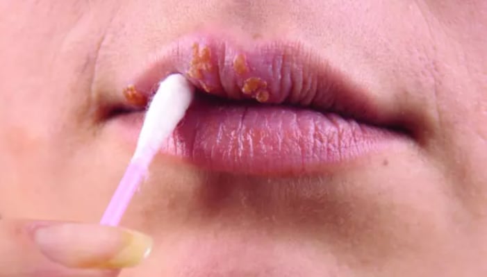 Este es el responsable de casi todos los cánceres de ano y garganta, que se asocia sólo con las mujeres