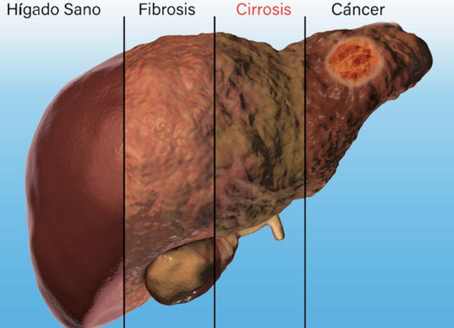 Los estados del hígado según el avance de las patologías