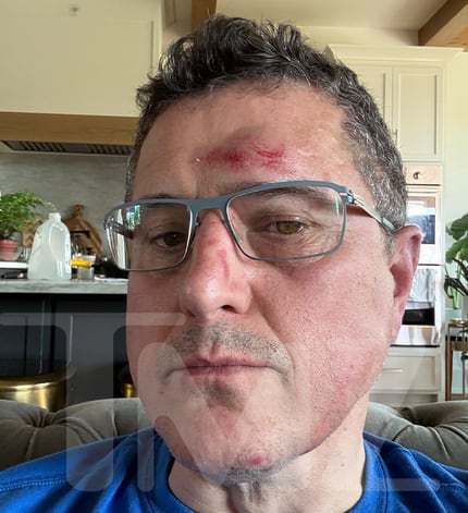 El vecino al que golpeó Alan Ritchson con las supuestas heridas que le hizo el actor. (Foto: TMZ)