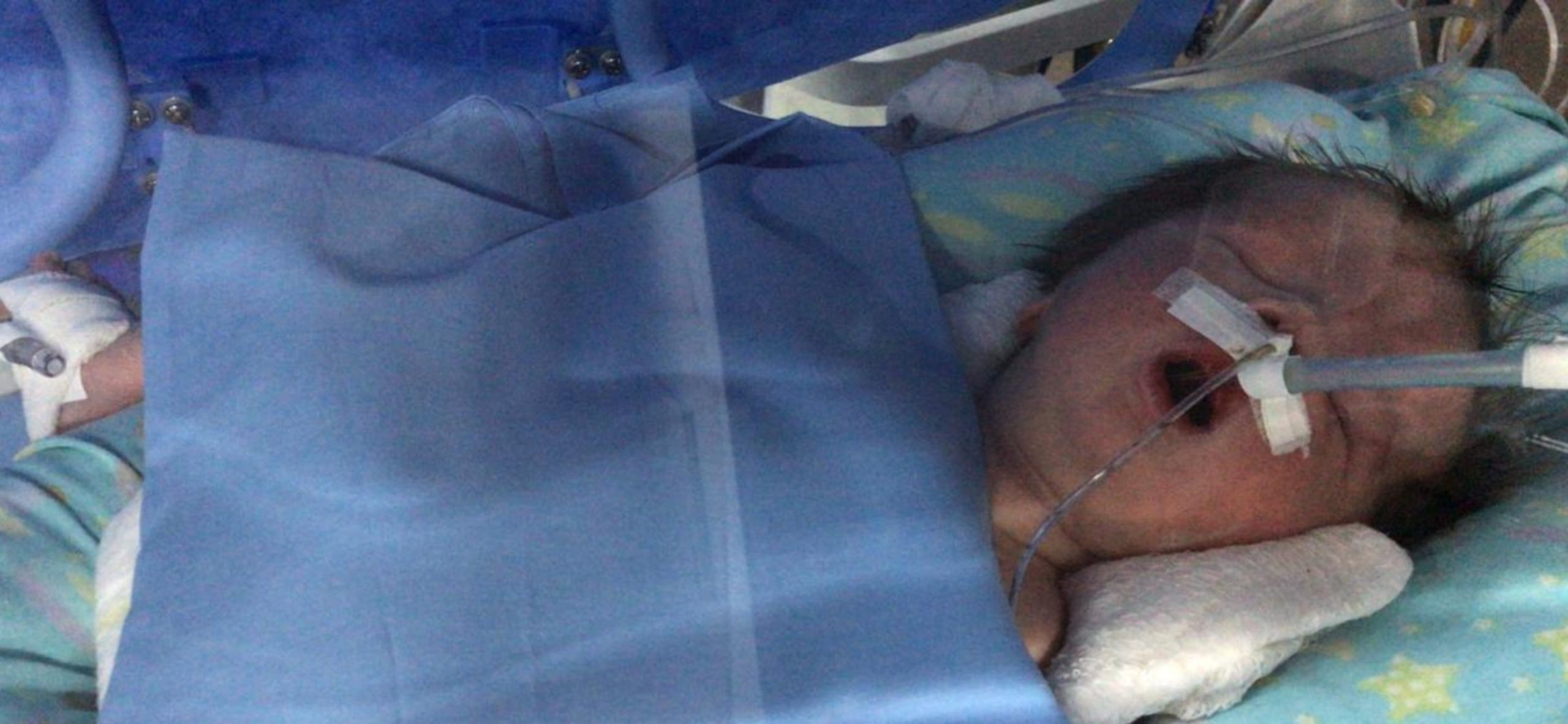 Milo nació con una hipoxia severa. No podía respirar por sus propios medios, estaba azul y sin tono muscular.