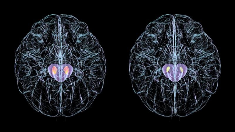 En las personas con párkinson, las células nerviosas de la región del cerebro conocida como sustancia negra, mueren. Izquierda: sustancia negra sana (naranja). Derecha: sustancia negra degenerada (amarilla).