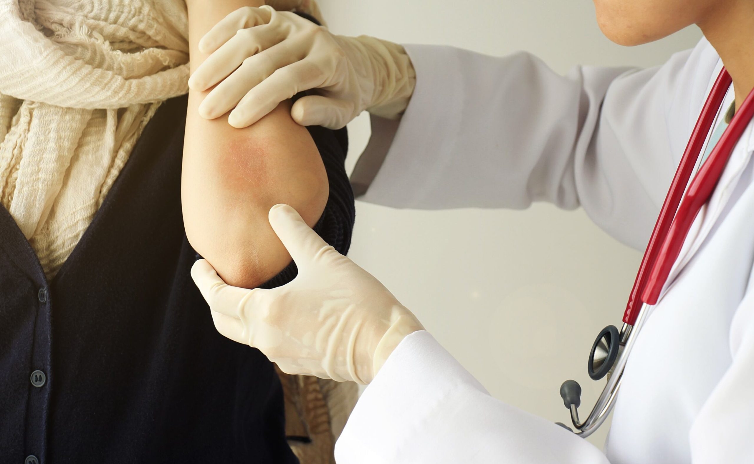 La psoriasis es una enfermedad que afecta de 800 mil a un millón de personas en Argentina. (Foto: Adobe Stock)
