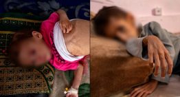 El rostro más silencioso de la guerra: desnutrición infantil en Gaza