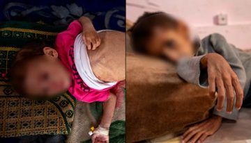 El rostro más silencioso de la guerra: desnutrición infantil en Gaza