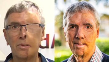 Hombre reconstruye su rostro tras accidente gracias a prótesis 3D