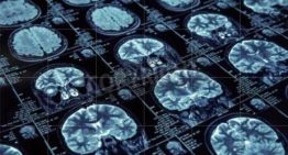 Un dispositivo de estimulación cerebral de uso doméstico logra mejorar los síntomas de depresión mayor