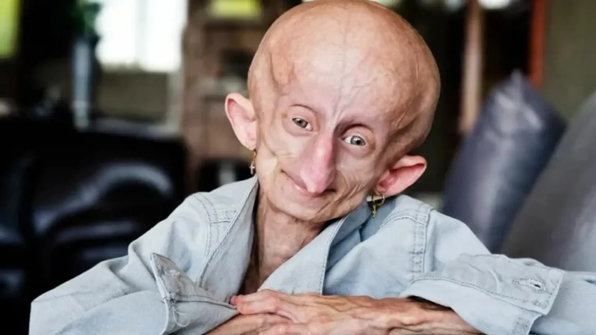 Muere a los 19 años Beandri Booysen, la 'influencer' que visibilizó su lucha contra la progeria