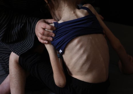 Imagen secundaria 1 - Rafah Ayyad, una palestina de 12 años en Gaza, muestra evidentes signos de desnutrición