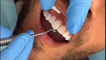Alerta sobre la nueva moda de viajar a Marruecos en busca de la sonrisa perfecta: «Es una temeridad»