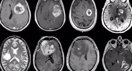 Crean células capaces de eliminar el glioblastoma, uno de los peores tumores cerebrales