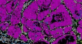 Prrx1, así es el gen que determina si las células de cáncer de mama forman metástasis o permanecen 'dormidas'