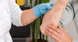 ¿Qué es la sarna noruega que está afectando a más de 30 personas en Galicia? ¿Tiene cura?