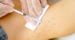 Hasta el 3% de la población sufre hiperhidrosis, el exceso de sudor que trastoca la vida: «Es un problema médico real y tratable»