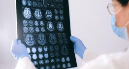 Los pacientes españoles esperan más de tres meses para una primera consulta de neurología: «Cada retraso diagnóstico supone una oportunidad perdida»