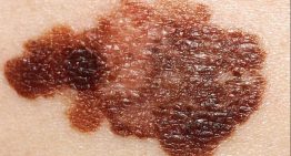 Las claves del melanoma, el cáncer de piel más agresivo con una vacuna en el horizonte