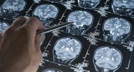 Los hospitales de Can Ruti y Sant Pau representarán a España en un gran estudio europeo sobre una prometedora cirugía para el alzhéimer