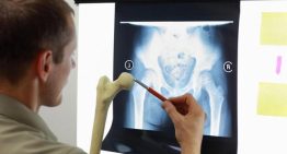 Las nuevas guías clínicas recomiendan evaluar la pérdida ósea en perimenopausia para evitar osteoporosis