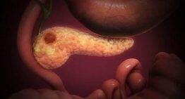 Así es 'Rasonque', la pastilla autorizada por Europa que duplica la supervivencia en cáncer de páncreas