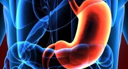 Cáncer de estómago: un tumor asintomático que tiene relación con el helicobácter pylori