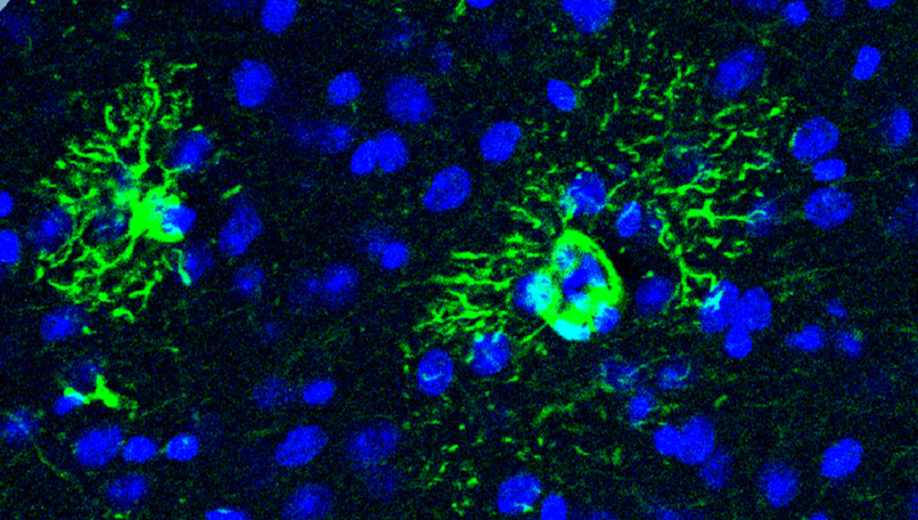 El Alzheimer comienza mucho antes que sus síntomas. Y hemos descubierto uno de sus primeros mecanismos