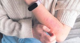 ¿Qué es la sarna? ¿Los afectados deben aislarse? Siete claves de una infección desbocada entre los jóvenes