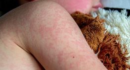 Sanidad recomienda reforzar la vigilancia y la vacunación ante el boom de casos de sarampión