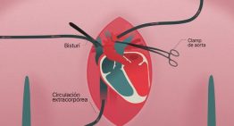 Las cuatro fases de una operación de trasplante de corazón