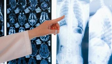 Las muertes por cáncer de pulmón en mujeres superan a las provocadas por tumores en la mama por primera vez en España
