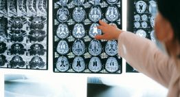 Los ictus se han convertido un enorme problema de salud silencioso en España. Y hay formas de limitar los riesgos