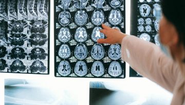 Los ictus se han convertido un enorme problema de salud silencioso en España. Y hay formas de limitar los riesgos