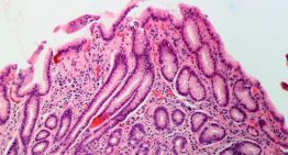Las infecciones por 'Helicobacter pylori' podrían desencadenar más de 11 millones de casos de cáncer gástrico en el mundo
