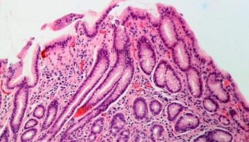 Las infecciones por 'Helicobacter pylori' podrían desencadenar más de 11 millones de casos de cáncer gástrico en el mundo