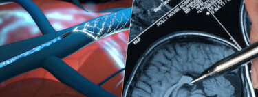 Synchron quiere aumentar su ventaja con Neuralink en la carrera por los chips cerebrales. Con un ensayo clínico masivo