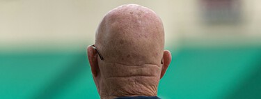El minoxidil parecía el gran medicamento milagro contra la calvicie. Una farmacéutica financiada por Google lo acaba de superar