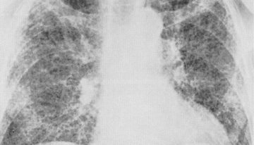 El Hospital de Bellvitge desarrolla una IA que diagnostica con rapidez la fibrosis pulmonar y predice su evolución