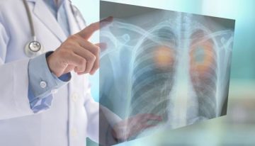 Las nuevas terapias revolucionan el manejo de la fibrosis quística: la supervivencia de los pacientes ya supera los 50 años