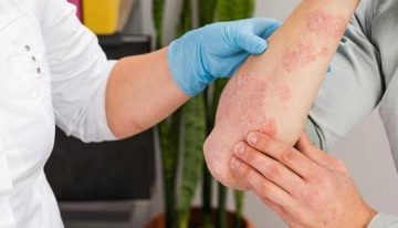 ¿Qué es la sarna noruega que está afectando a más de 30 personas en Galicia? ¿Tiene cura?