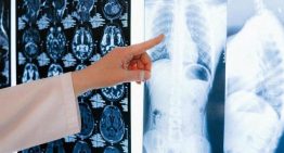 Una terapia oral diaria muestra resultados «extraordinarios» en cáncer de pulmón avanzado