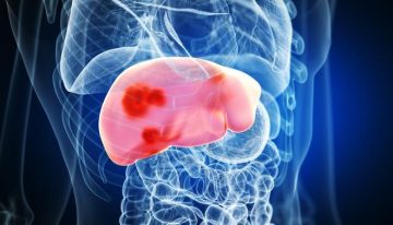 Los médicos alertan de la rápida progresión de la hepatitis Delta y de su relación con el cáncer de hígado