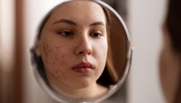 El estrés, las dietas y las rutinas cosméticas disparan el acné entre las mujeres jóvenes: «Me veo y quiero llorar»
