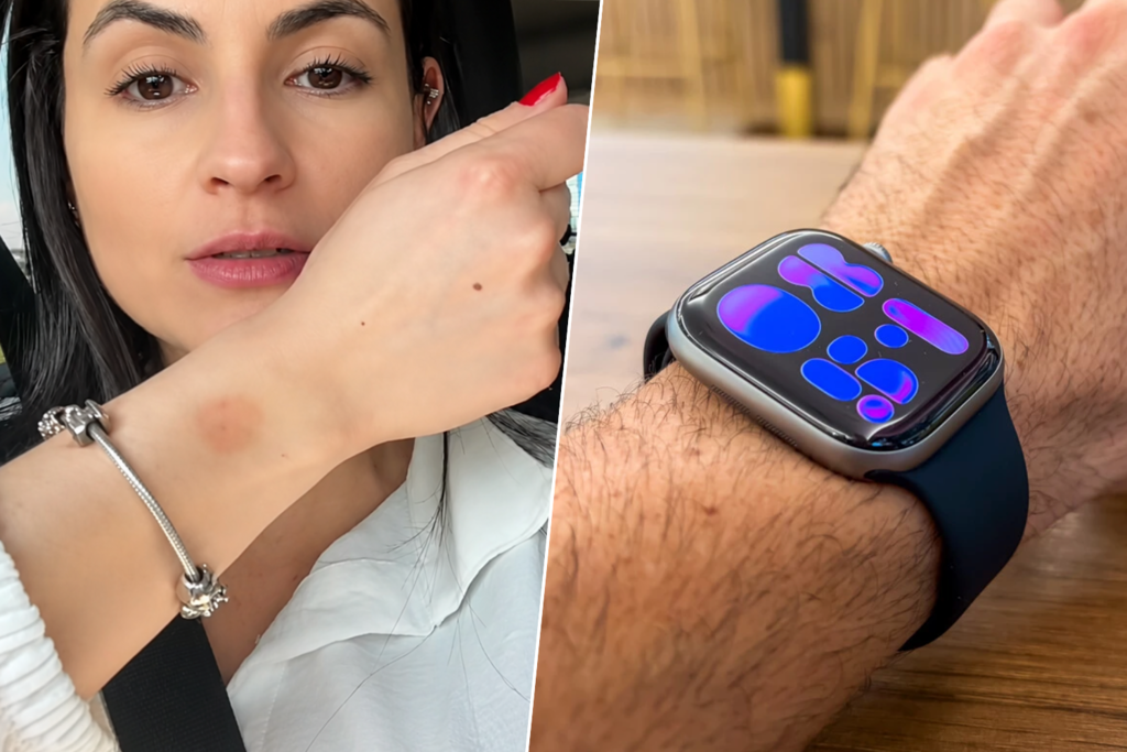 Llevamos el Apple Watch tantas horas que ya hay un nombre para el problema que puede provocar en la piel: "watch rot" 