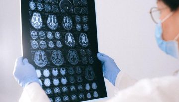 Los pacientes españoles esperan más de tres meses para una primera consulta de neurología: «Cada retraso diagnóstico supone una oportunidad perdida»