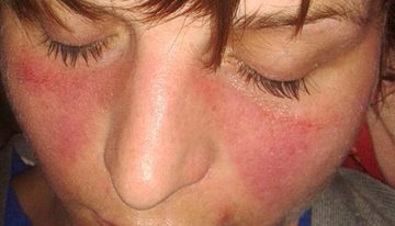 Vall d'Hebron investiga una crema contra el lupus cutáneo que ha reducido un 90% las lesiones en estudios preliminares