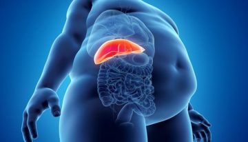 El 80% de jóvenes con sobrepeso padecen hígado graso, enfermedad que puede producir cirrosis o cáncer