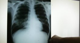 Salut Pública investiga un brote de tuberculosis con más de 25 afectados en Barcelona