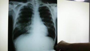 Salut Pública investiga un brote de tuberculosis con más de 25 afectados en Barcelona