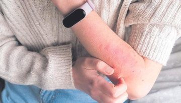 ¿Qué es la sarna? ¿Los afectados deben aislarse? Siete claves de una infección desbocada entre los jóvenes